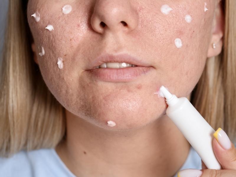 Zinc Oxide Powder Uses for acne